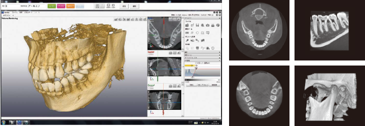 歯科用CT撮影画像