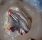 歯の保存
